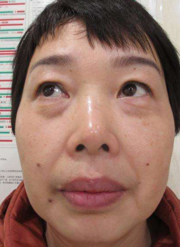 去眼袋手术