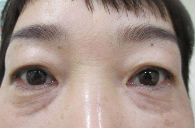 去眼袋手术