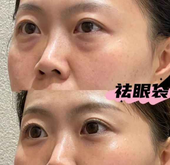 去眼袋手术