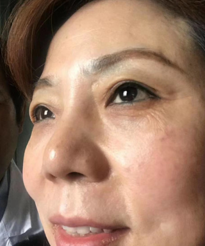 去眼袋手术