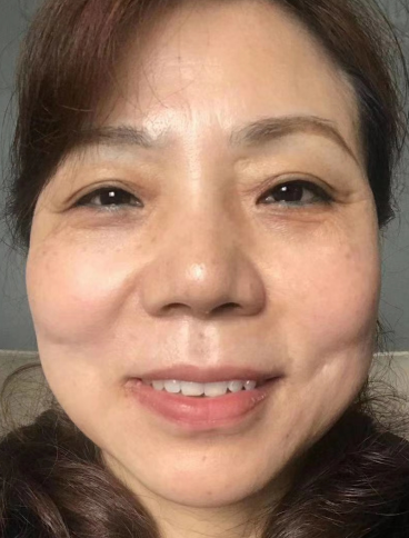 去眼袋手术