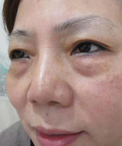 去眼袋手术