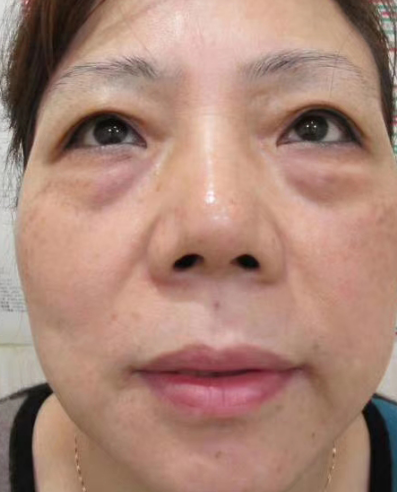 去眼袋手术