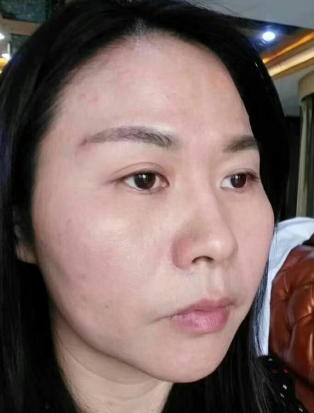 去眼袋手术