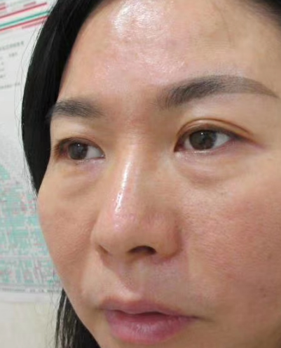 去眼袋手术