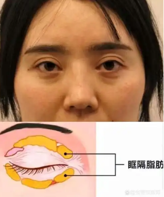 去眼袋手术