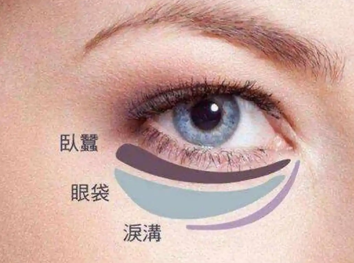 去眼袋手术