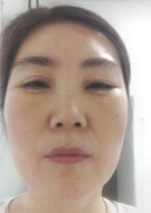 去眼袋手术