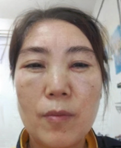 去眼袋手术