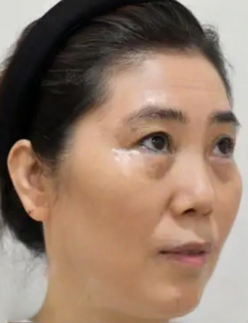 去眼袋手术