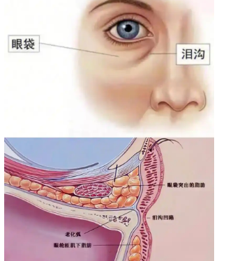 去眼袋手术
