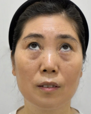 去眼袋手术