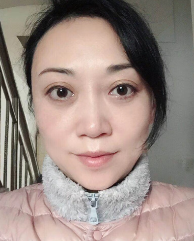 去眼袋手术