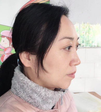 去眼袋手术