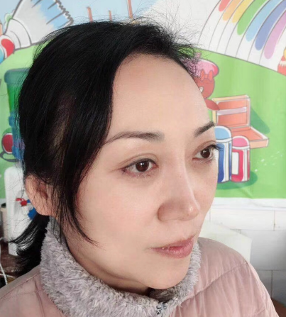 去眼袋手术