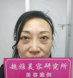 去眼袋手术