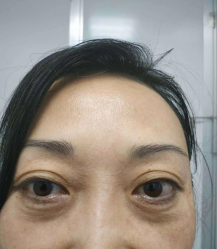 去眼袋手术
