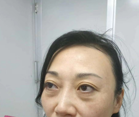 去眼袋手术