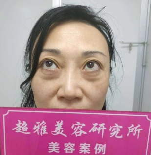 去眼袋手术