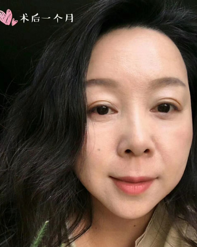 去眼袋手术