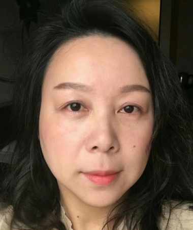 去眼袋手术