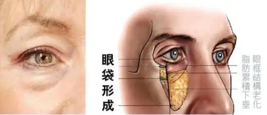 去眼袋手术