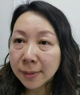 去眼袋手术