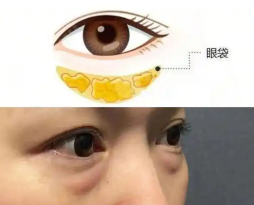 去眼袋手术