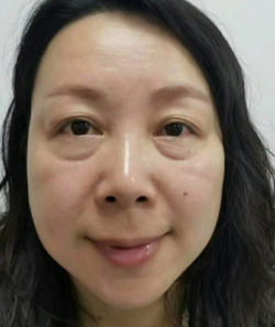 去眼袋手术