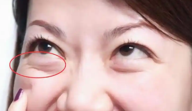 眼袋
