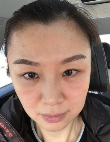 去眼袋手术