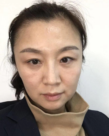 去眼袋手术