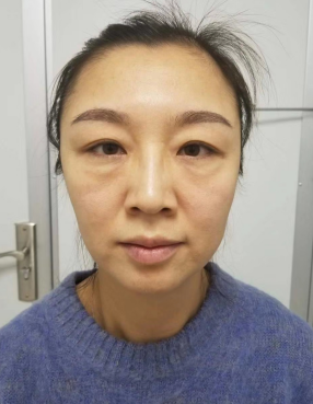 去眼袋手术