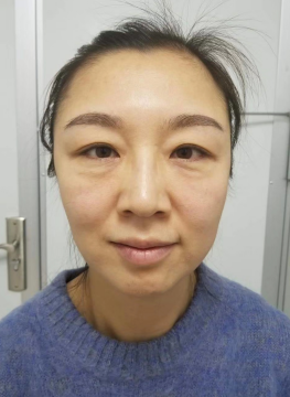 去眼袋手术