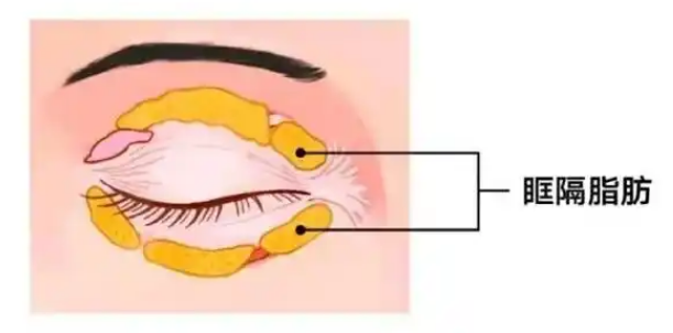去眼袋手术