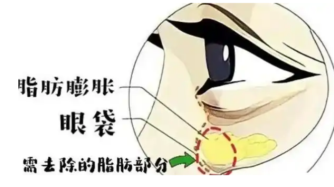 去眼袋手术
