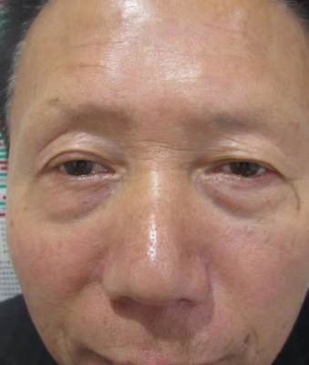 去眼袋手术