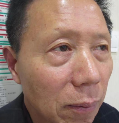 去眼袋手术