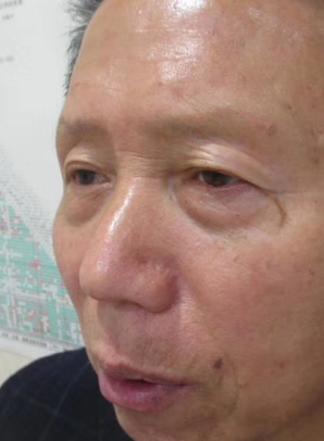 去眼袋手术