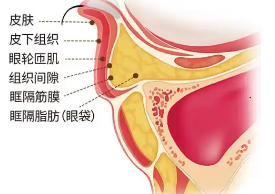去眼袋手术