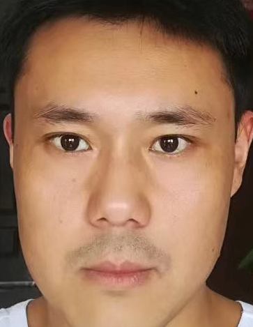 去眼袋手术
