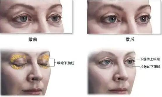 去眼袋手术