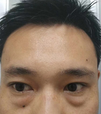 去眼袋手术