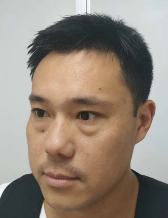 去眼袋手术