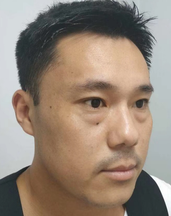 去眼袋手术