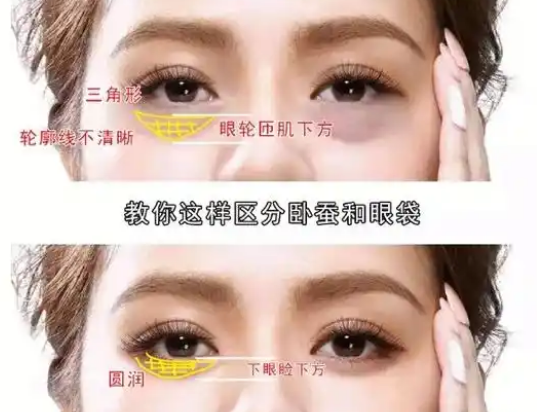 去眼袋手术