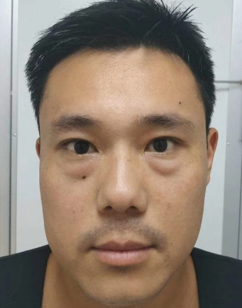 去眼袋手术