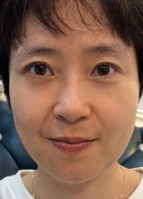 去眼袋手术