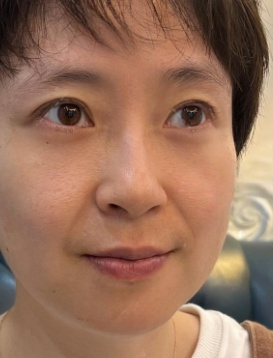 去眼袋手术
