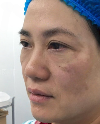 去眼袋手术